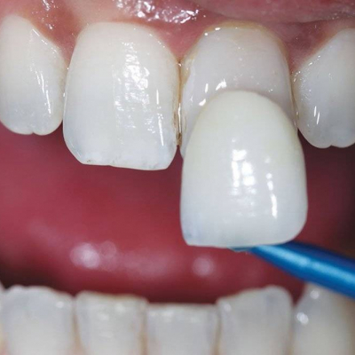 Dental restoration at the Corona Dental Clinic in Barcelona