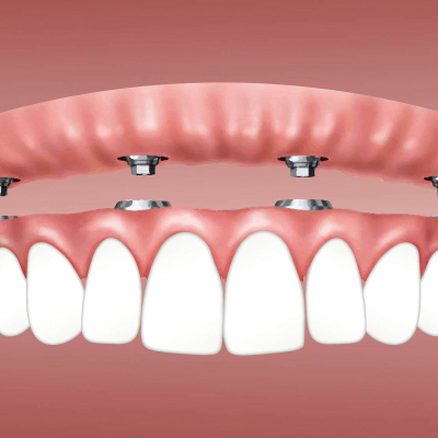 Dental Prosthetics: A Variety of Methods and Materials