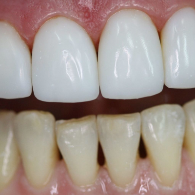 Ästhetische Zahnrestaurierung